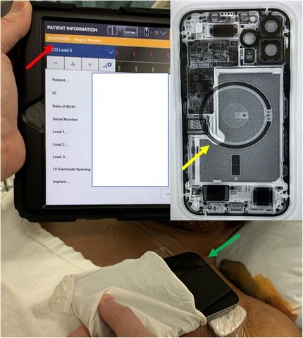 Cảnh Báo: iPhone 12 và Phụ Kiện MagSafe Có Thể Ảnh Hưởng Đến Máy Tạo Nhịp Tim và Thiết Bị Y Tế